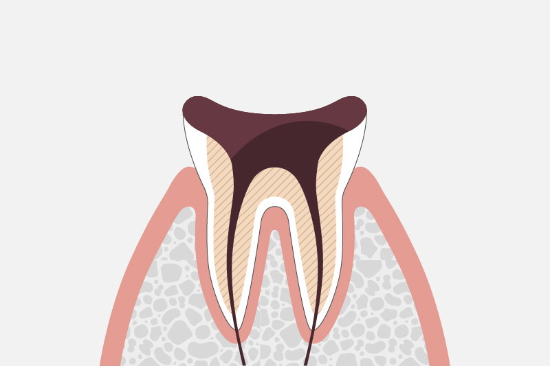 歯質が失われた虫歯